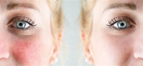 Premium Photo Before And After Laser Treatment For Rosacea