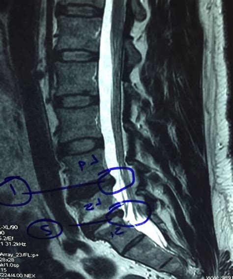 Hernia de disco 2 niveles Dr Jose Mario Dorantes Rodríguez