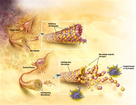 New Brain Imaging Shows Tau Protein Prediction of Alzheimer's