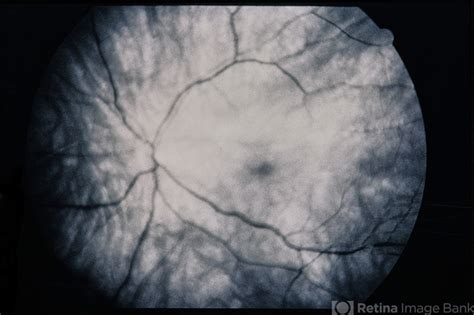 Plaquenil Toxicity Retina Image Bank