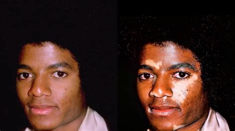Vitiligo Michael Jackson Proof