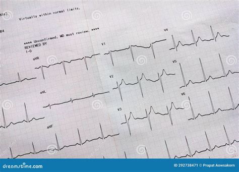 Graph Showing The Results Of The Electrocardiogram Test On Recording