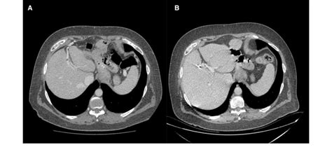 A Computed Tomography Ct Scan With Intravenous Contrast Portal