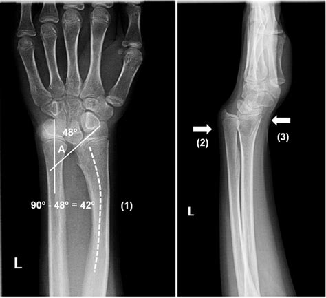 Deformidad Articular No Traumática En Paciente Adolescente