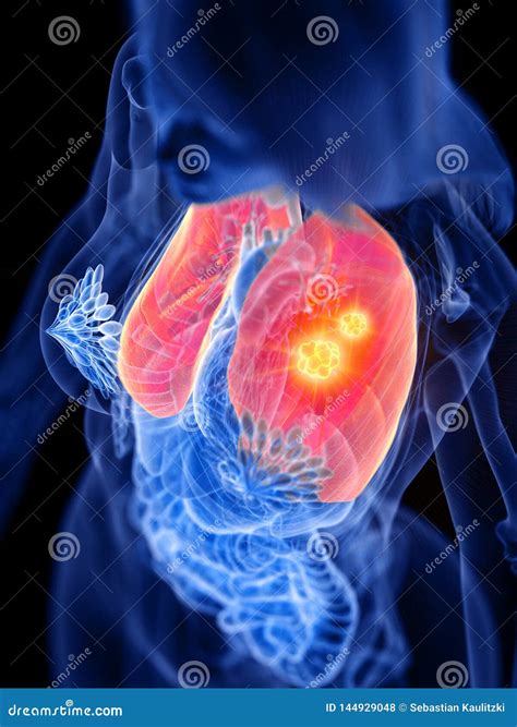 A Womans Lung Tumor Stock Illustration Illustration Of Medically