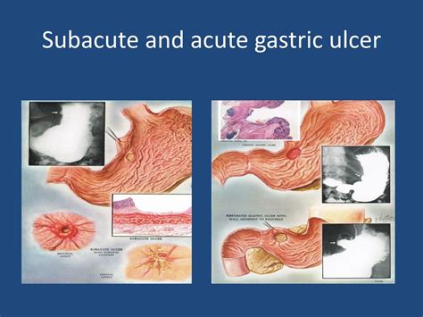 Ppt Disorders Of The Gastrointestinal System Part 1 Powerpoint Presentation Id1023471