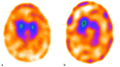 Trodat Spect Images A Normal Radiotracer Uptake Of Basal Ganglia