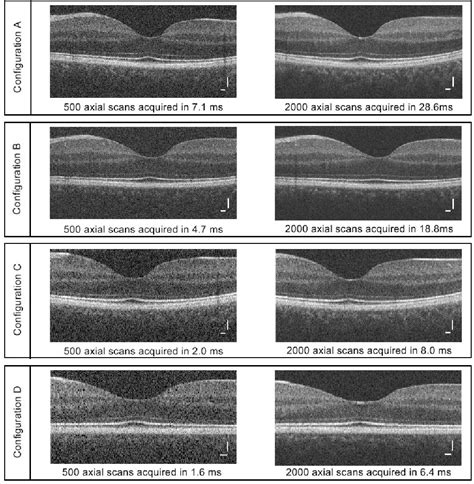 Figure 1 From Ultrahigh Speed Spectral Fourier Domain OCT Ophthalmic