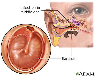 Ear Infection Chronic Uf Health