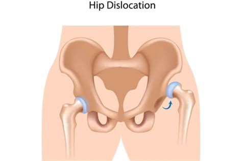 Hip Dislocation: Causes, Symptoms, treatment & Prevention