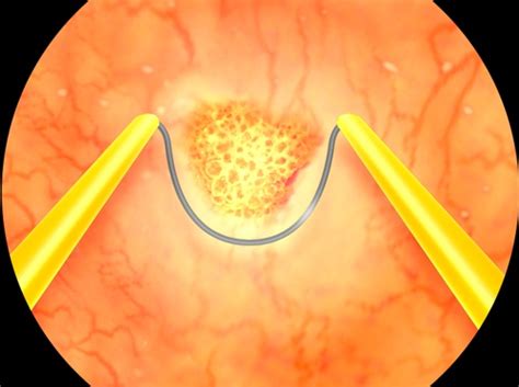 Video Transurethral Resection Of Bladder Tumor Tur Or Turbt