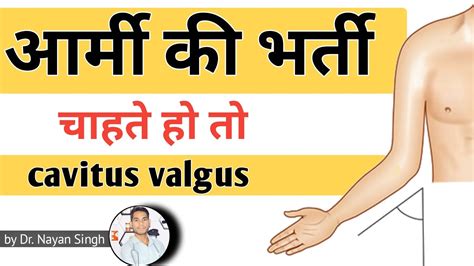 Army Cubitus Valgus Bilateral Treatment In Hindi Cubitus Valgus Vs