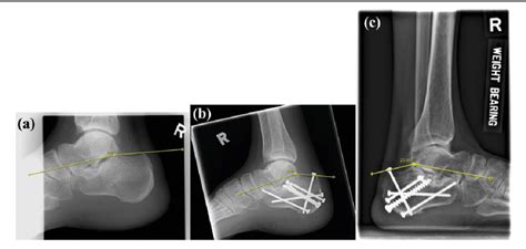 Figure 1 From Subtalar Arthroscopy And Fluoroscopy In Percutaneous