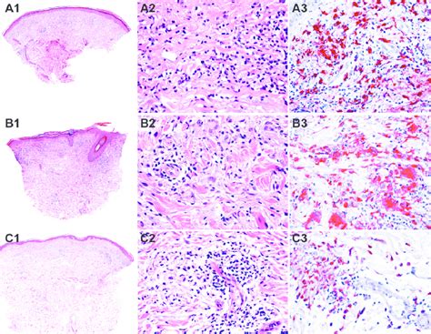 Granulomatous Infiltrates In Three Examples Of Acrodermatitis Chronica