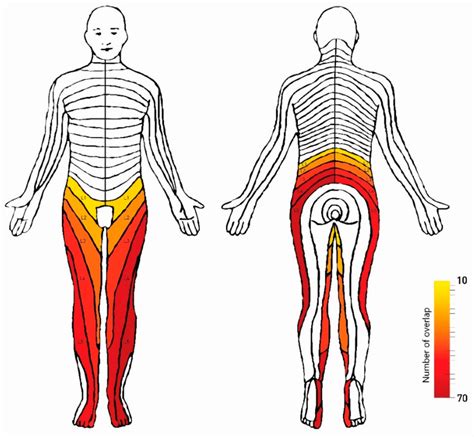 Nerve Root Dermatome Distribution Correlation Dermatomes Chart And Map