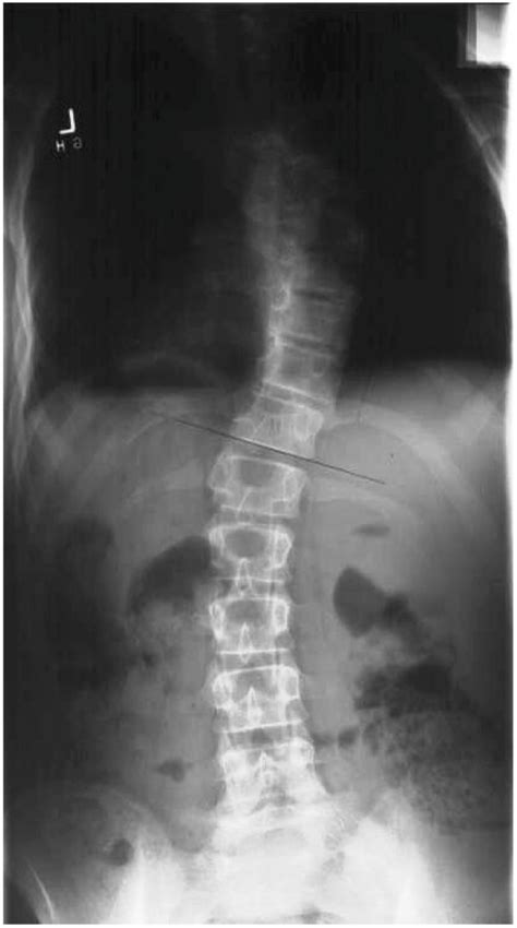 Pa Plain Radiograph Turner Syndrome Scoliosis Download Scientific