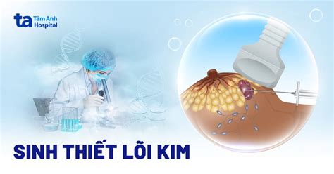 Sinh Thiết Lõi Kim Cnb ở Vú Chỉ định Quy Trình Và Kết Quả