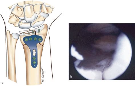 Chapter 17 Arthroscopically Assisted Fixation Of Intra Articular Distal Radius Fractures