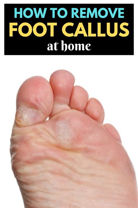 The Best Ways To Get Rid Of Calluses Artofit