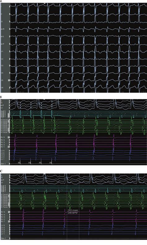 A 12 Lead Ecg And Intracardiac Electrograms With Catheters In The Right