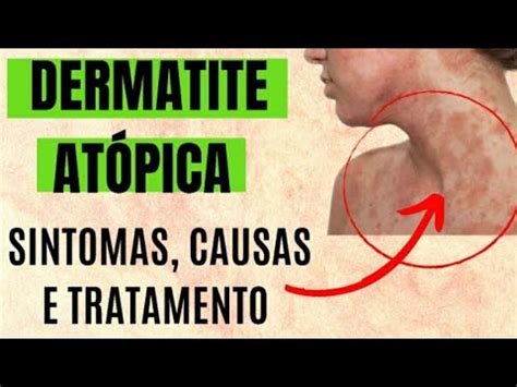 Dermatite Atópica sintomas causas tratamentos YouTube