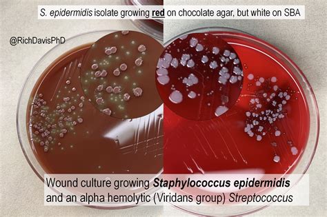 Staphylococcus Aureus Wound Hot Sex Picture