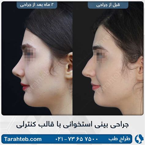 نمونه تصاویر قبل و بعد از جراحی بینی طراح طب