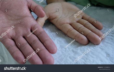 Pallor Anaemia Comparing Normal Anaemic Hands ภาพสต็อก แก้ไขตอนนี้