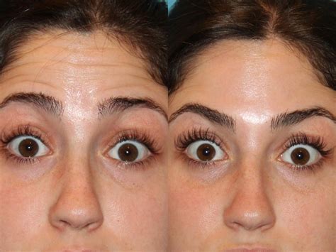 Botox® Cosmetic Before And After Photo Gallery Atlanta Georgia