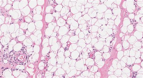 Well Differentiated Liposarcoma Atlas Of Pathology