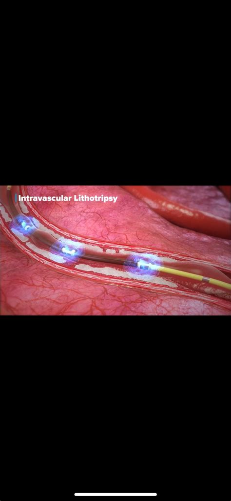 Tecnologia In Dita Para Desobstru O De Art Ria Femoral Utilizada