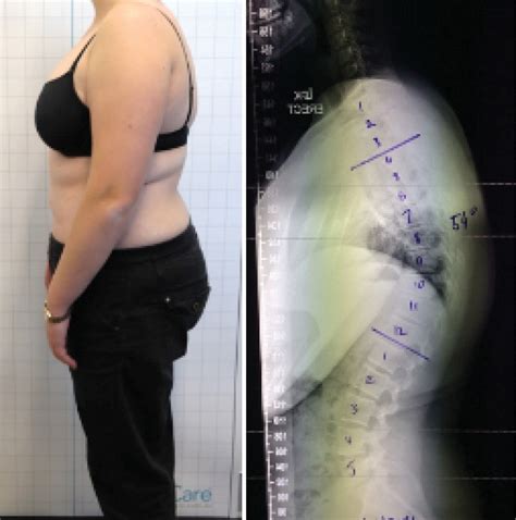 Reduction Of A Hyper Kyphosis In A 16 Year Old Female Patient Using A