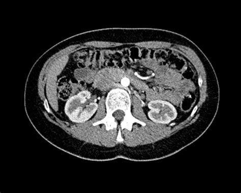 What Is An Abdominal Or Abdomen CT Scan Two Views