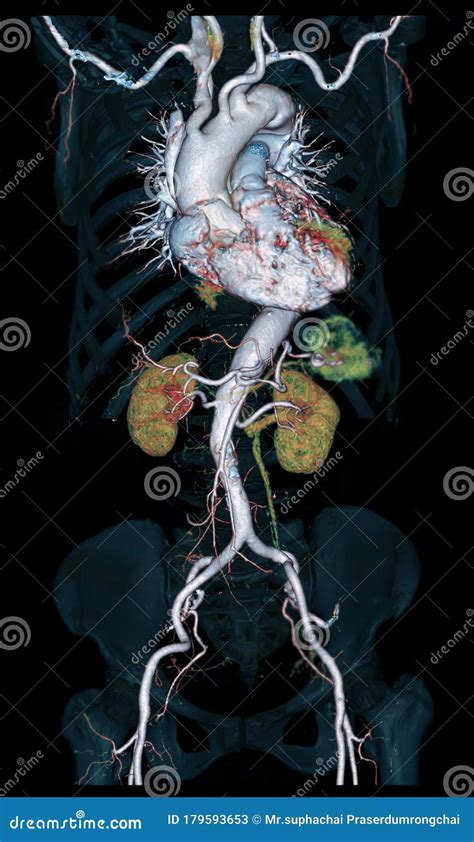 CTA Whole Aorta 3D Rendering Image Stock Illustration Illustration