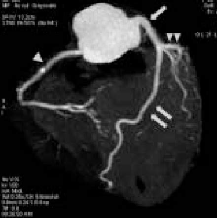 Figure 1 From Cardiovasculaire Diagnostic Dun Infarctus Aigu Du