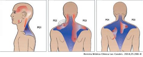 Punci N Seca En Fisioterapia Qu Es Y Para Que Se Utiliza Cio Salud