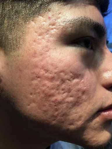 Subcision Acne Scar Treatment Acne Scar Irvineskin Irvine