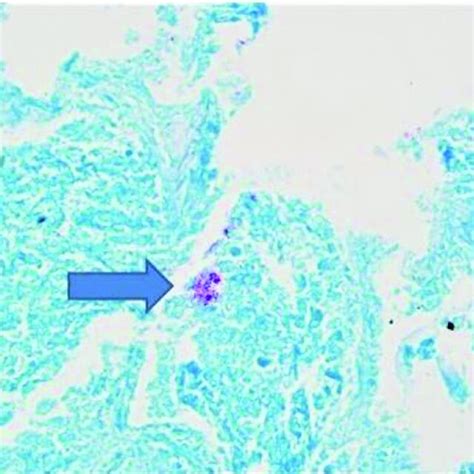 Granulomatous Inflammation With Positive Afb Stain Histopathologic