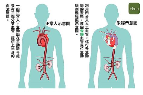 罕見血管異位主動脈剝離手術，大林慈濟獨創術式拆彈救命！ Heho健康 Line Today