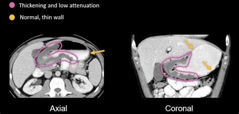 Abdominal Ct Peptic Ulcer Disease • Litfl • Radiology Library