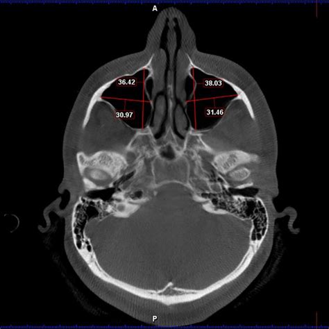 Width Of The Maxillary Sinus Mediolateral Distance And Depth Of