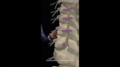 The Potential Of Posterior Cervical Laminoplasty For Spinal Cord