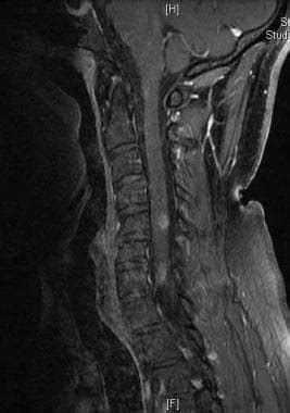 Neurosarcoidosis Imaging Practice Essentials Computed Tomography