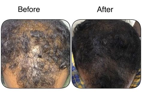 PRP Therapy | M A Skin & Hair Superspeciality Clinic - Dr. Manoj ...
