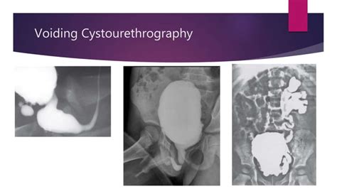 Posterior Urethral Valve Ppt