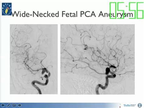 Adel Malek：neuroform Atlas支架在颅内动脉瘤治疗中的应用丨ocin2017精彩回顾 脑医汇 神外资讯 神介资讯