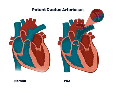 Patent Ductus Arteriosus A Congenital Condition The Pulse