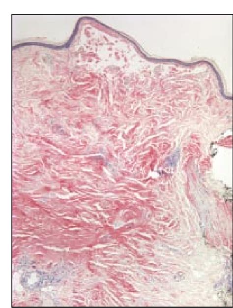 Figure 3 From Primary Localized Cutaneous Nodular Amyloidosis And Crest Syndrome A Case Report