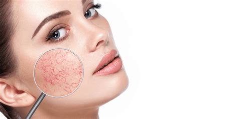 Spider Veins On Face Reasons And Treatment Of It