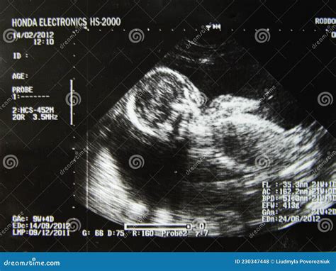 Ecograf A Por Ultrasonograf A Obst Trica Ecograf A De Un Feto De Cuarto